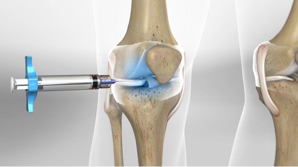 singjoint hyaluronic acid injection for knee pain